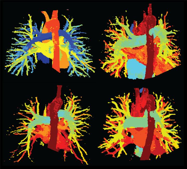 Pulmonary Transit Time in&nbsp;Technicolor